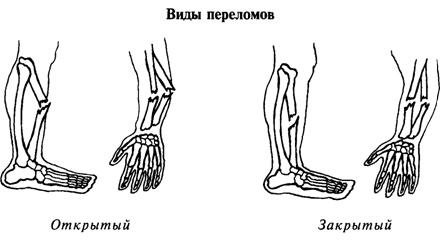 Схема открытого и закрытого перелома