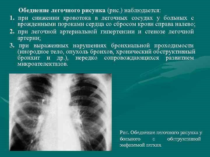Обогащен легочный