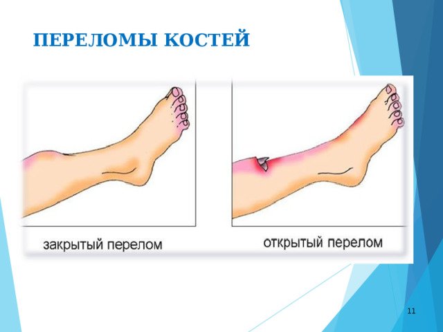 Открытые и закрытые переломы