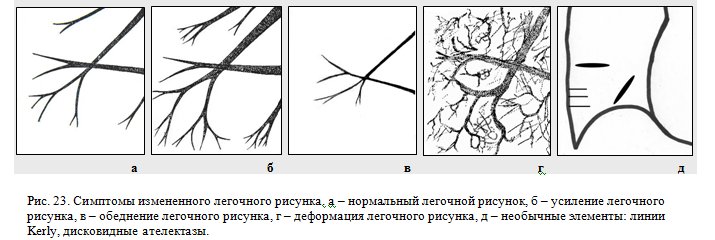 Легочный рисунок деформирован по сетчато-петлистому типу