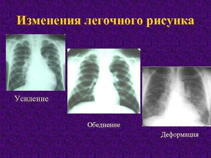 Рентген деформация оеговного р сунка