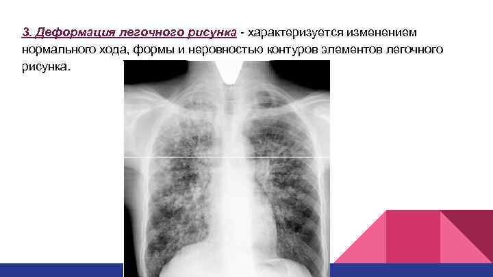Легочный рисунок деформирован