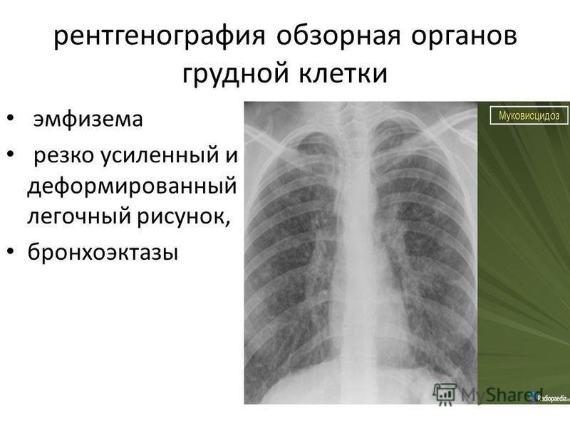 Деформация легочного рисунка