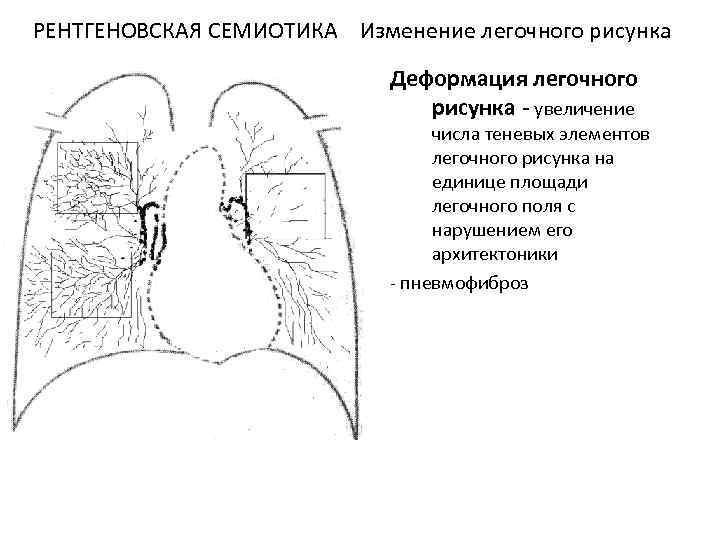 Ячеистая деформация легочного рисунка рентген