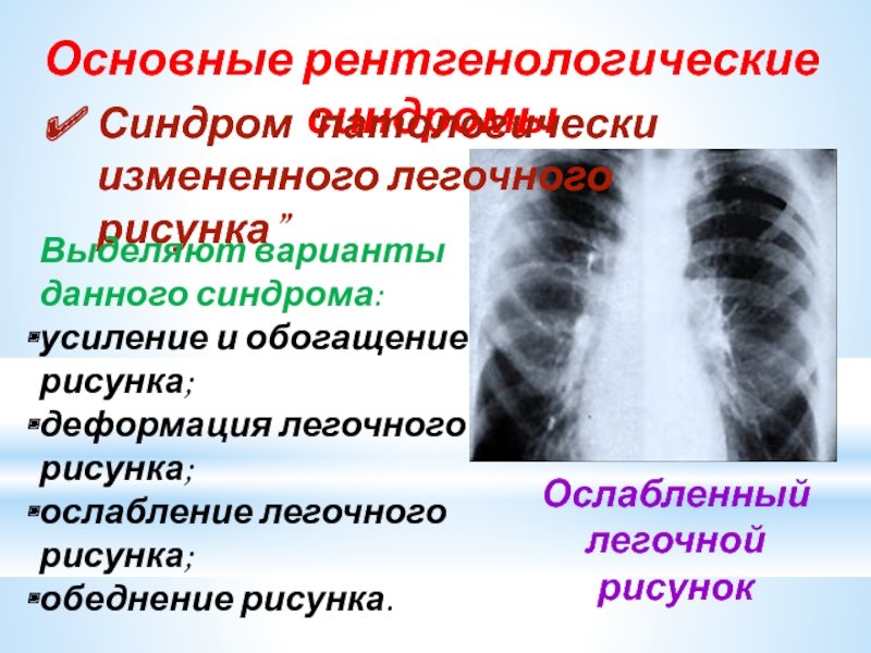 Усиление легочного рисунка на рентгене
