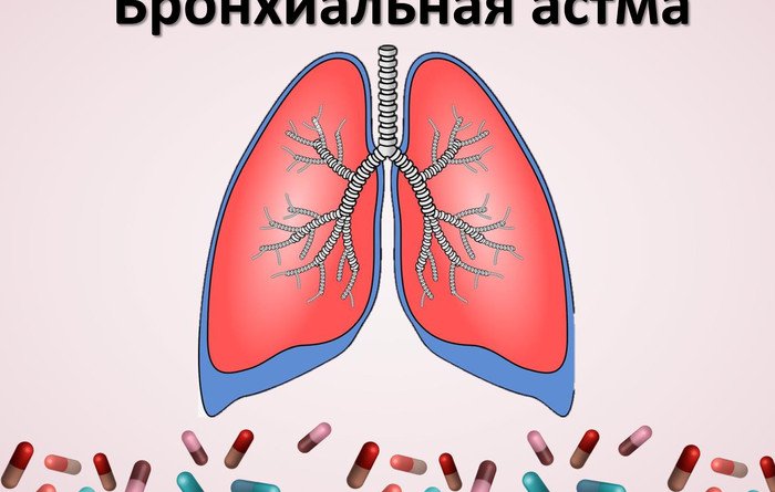 Бронхиальная астма рисунок