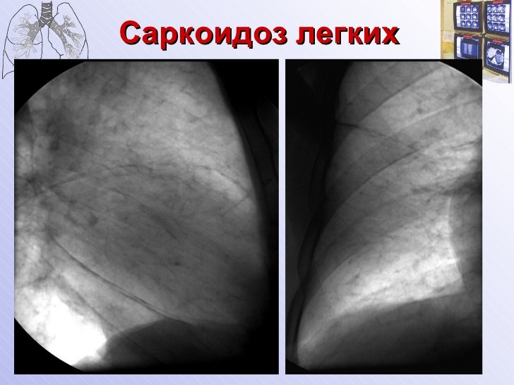 Деформация легочного рисунка