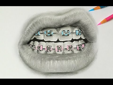 Рисунок брекетов карандашом
