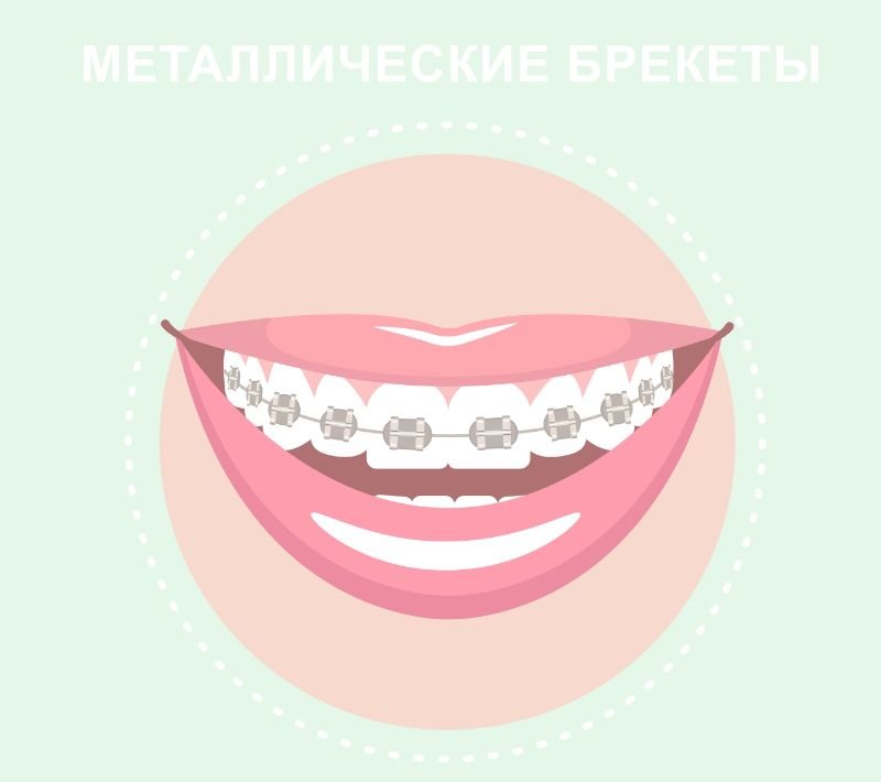 Брекеты рисунок