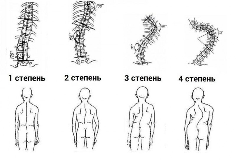 Сколиоз позвоночника схема