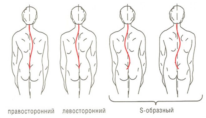 S образный сколиоз правосторонний грудной