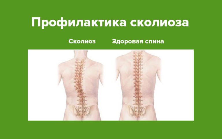 Сколиотическая деформация грудного отдела позвоночника