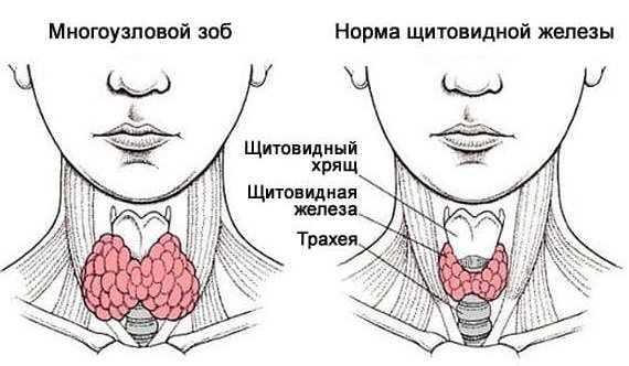Узловой зоб щитовидной железы