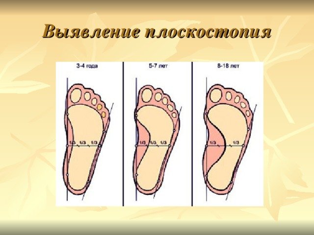Выявление плоскостопия у детей