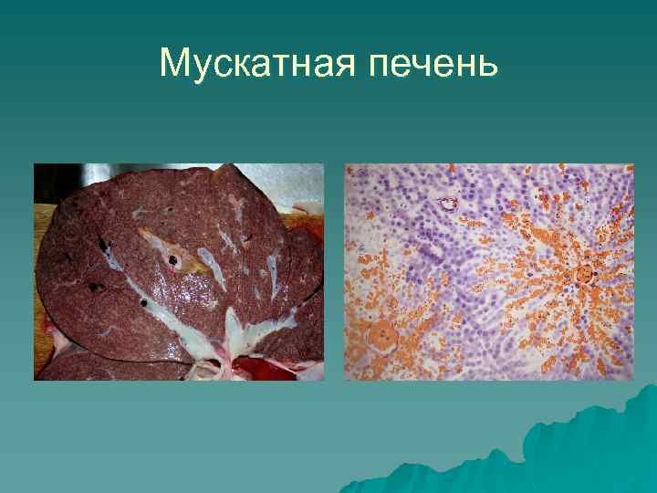 Мускатная печень микропрепарат патанатомия