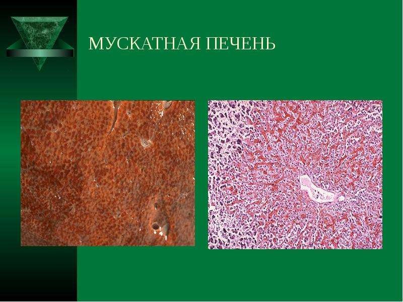 Мускатная печень патологическая анатомия