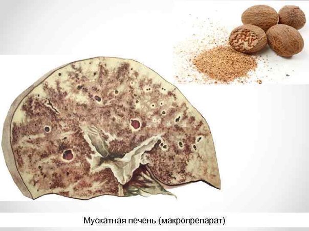 Патанатомия Макропрепараты цирроз печени