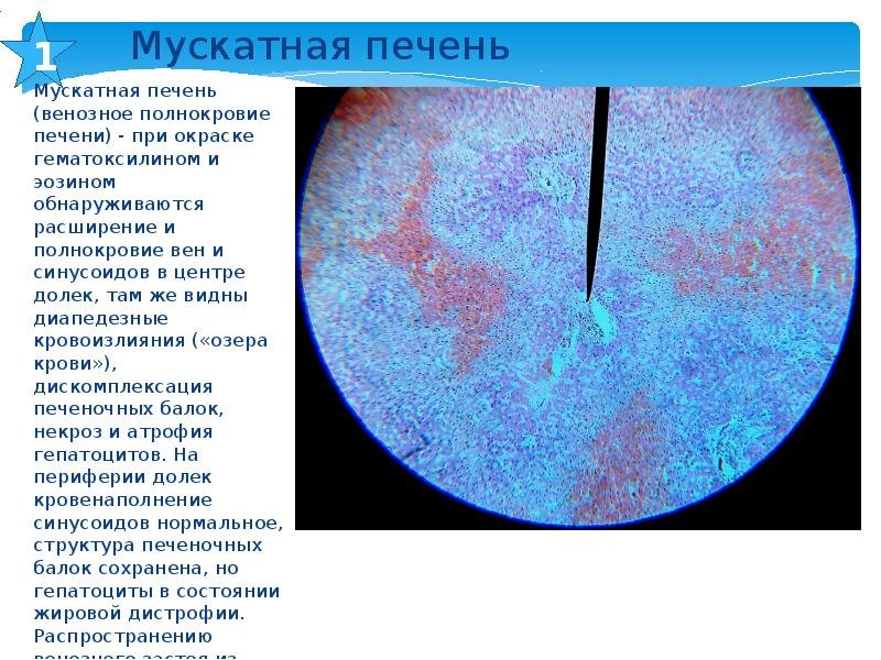 Мускатная печень (окраска гематоксилином-эозином).