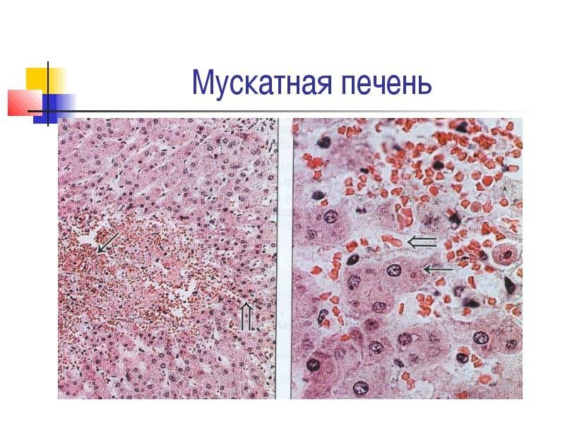 Мускатная печень патанатомия