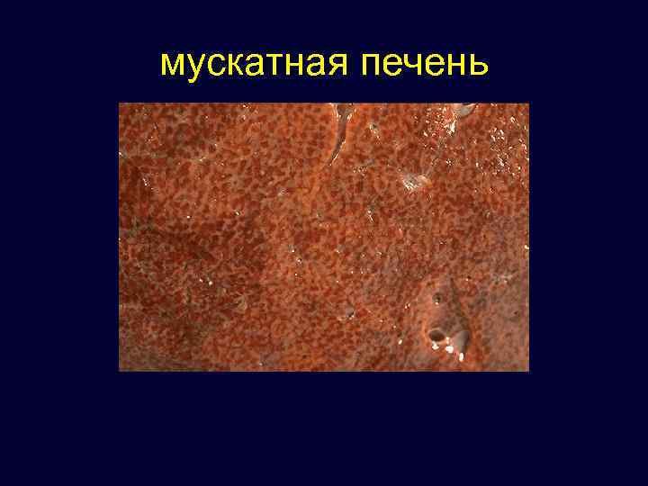 Мускатная печень макропрепарат патанатомия