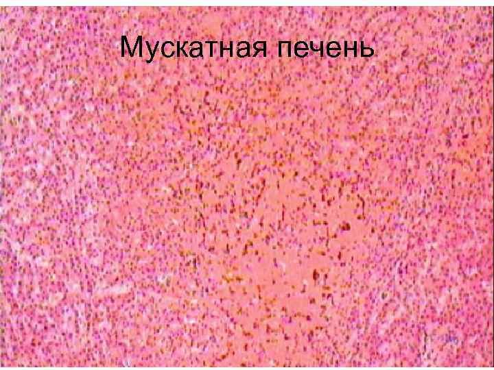 Мускатная печень макропрепарат патанатомия