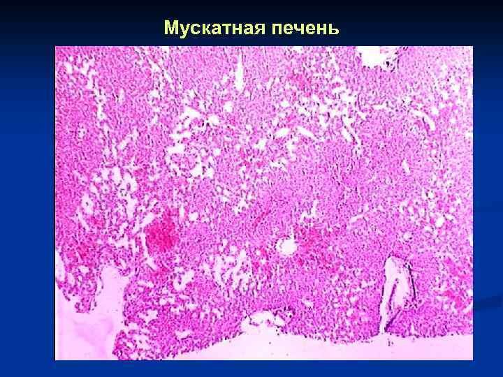 Мускатная печень гистология