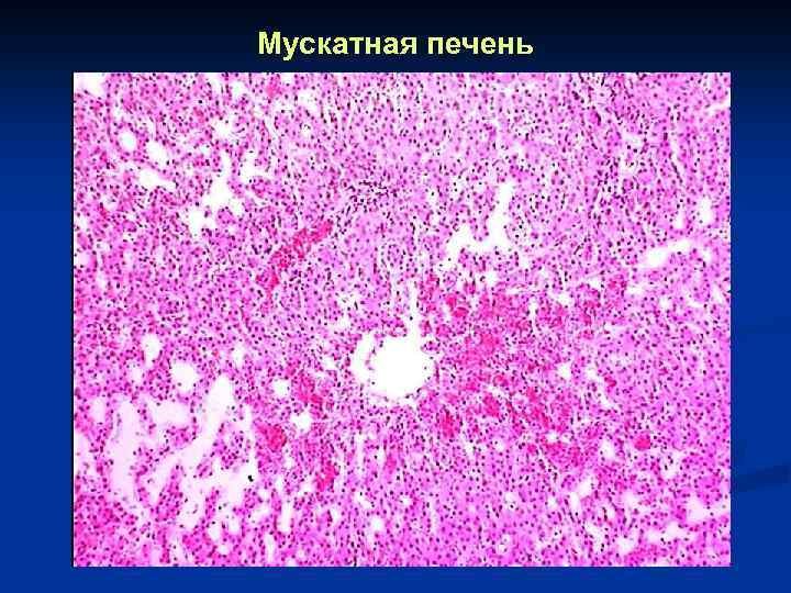 Мускатная печень макропрепарат патанатомия