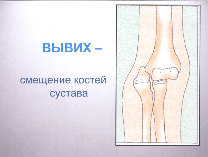 Рисунок растяжения сустава
