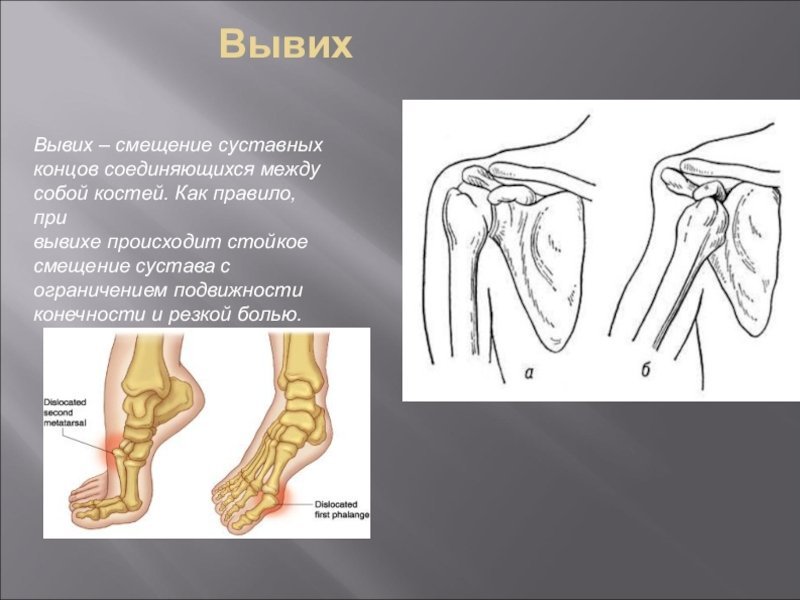 Вывих