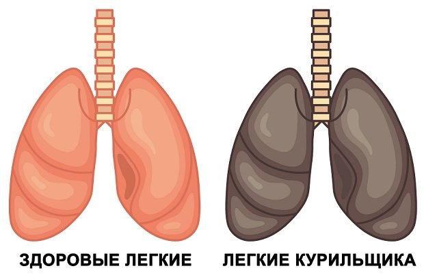 Лёгкие здорового человека и курильщика