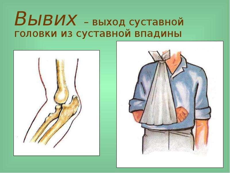 Вывих повреждения растяжения