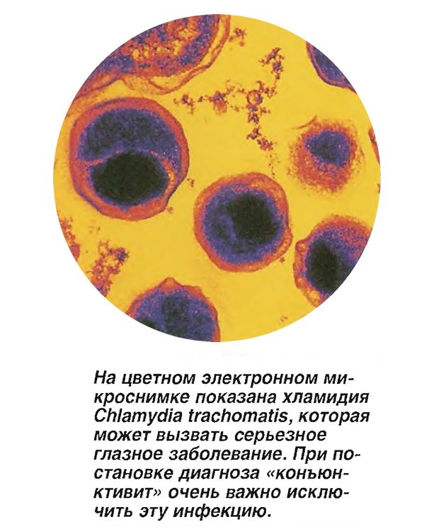 Заболевание глаз хламидиоз