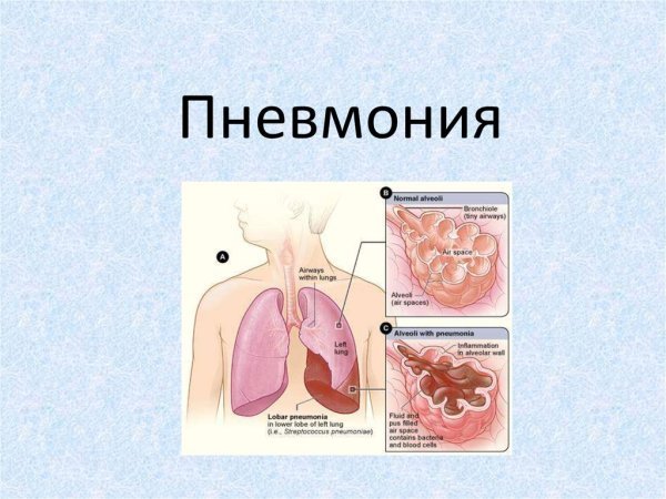 Пневмония