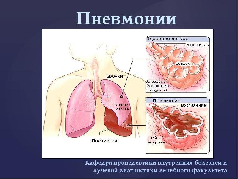 Пневмония презентация
