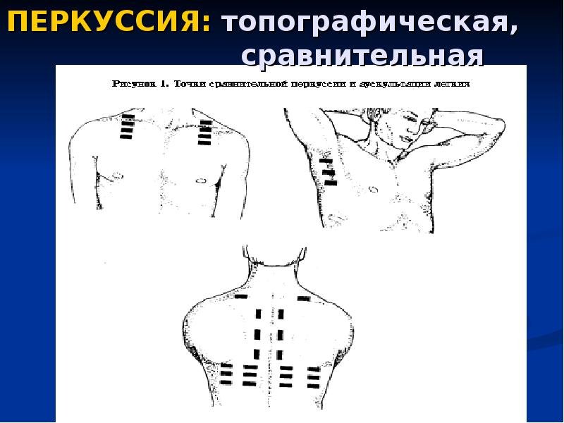 Топографическая перкуссия грудной клетки