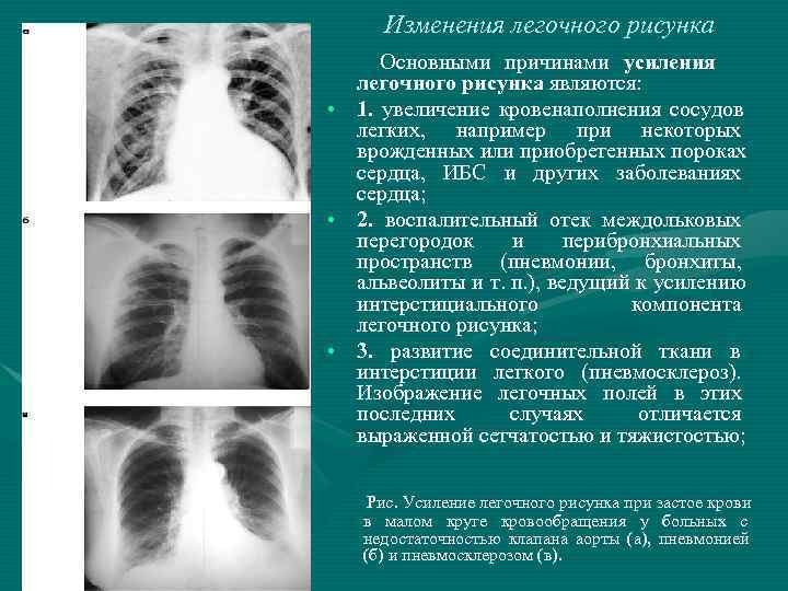 Усилен сосудистый