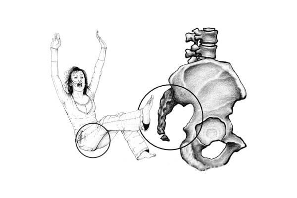 Кокцигодиния копчика рентген