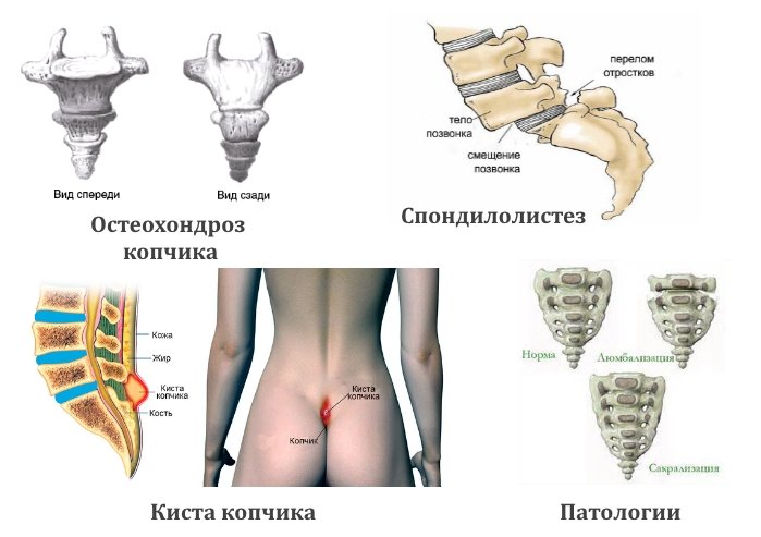 Крестцово-копчиковый отдел позвоночника