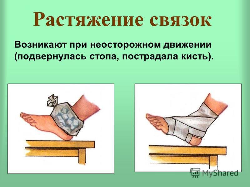 Оказание первой медицинской помощи при растяжении связок