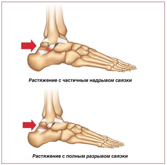 Растяжение связок 1 степени