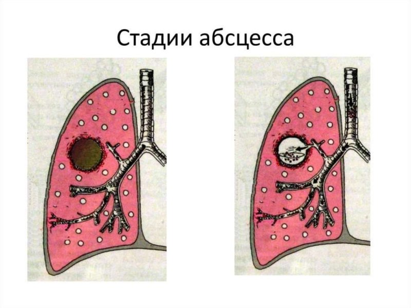 Абсцесс лёгкого стадии