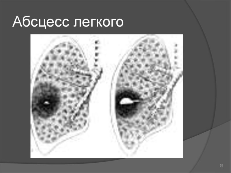 Острый абсцесс легкого