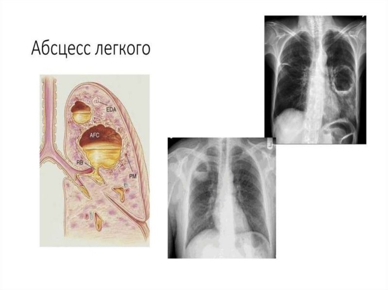 Абсцесс пневмония рентгенограмма