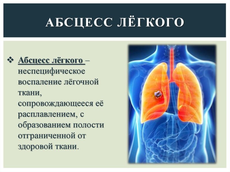 Абсцесс легких презентация