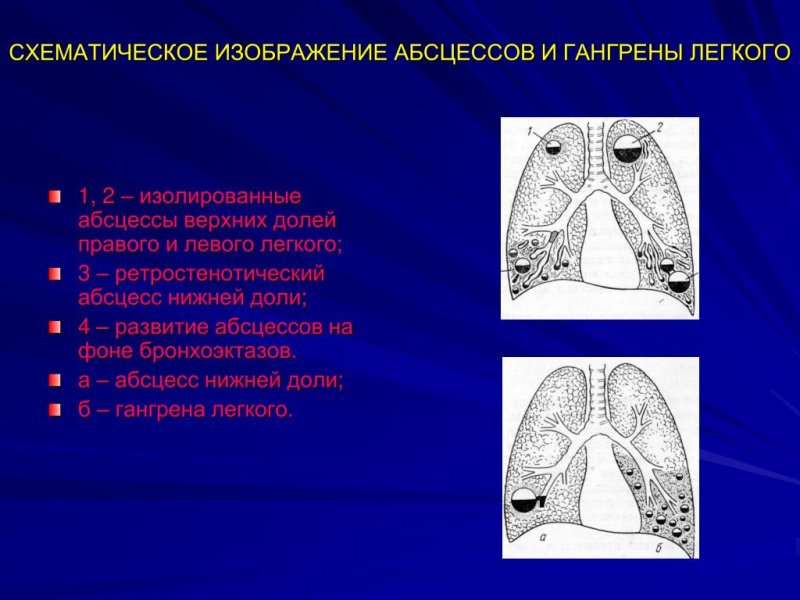 Множественный абсцесс легкого