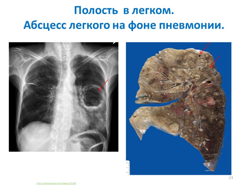 Синдром полости в легочной ткани рентген