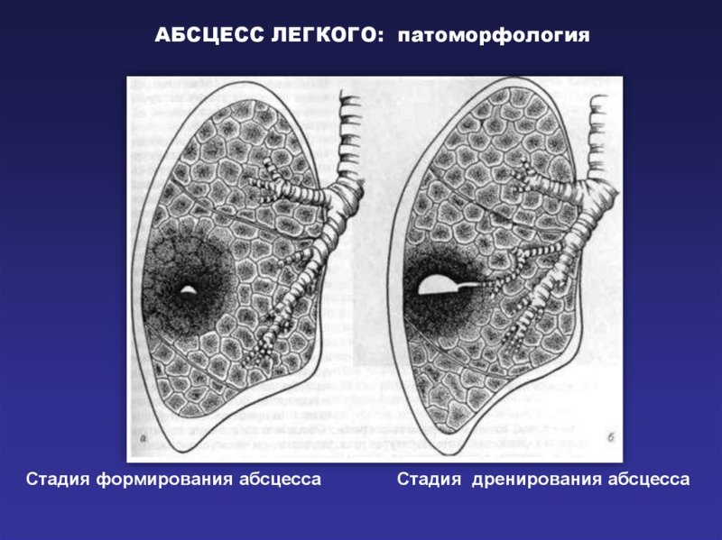 Абсцесс легкого патоморфология