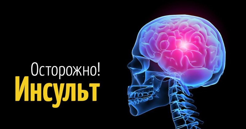 Инсульт картинки