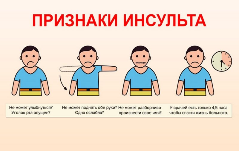 Основные критерии инсульта