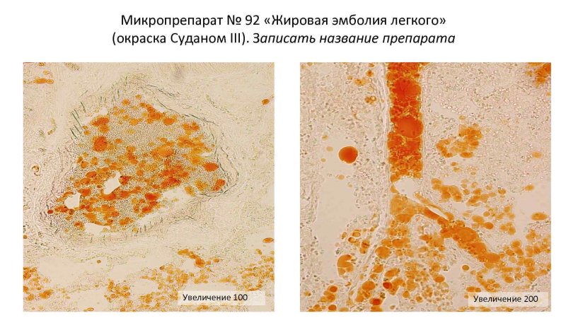 Жировая эмболия легкого Судан 3